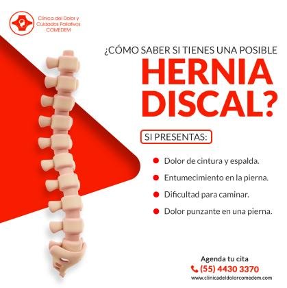 ¿Cómo saber si tienes una posible hernia discal?